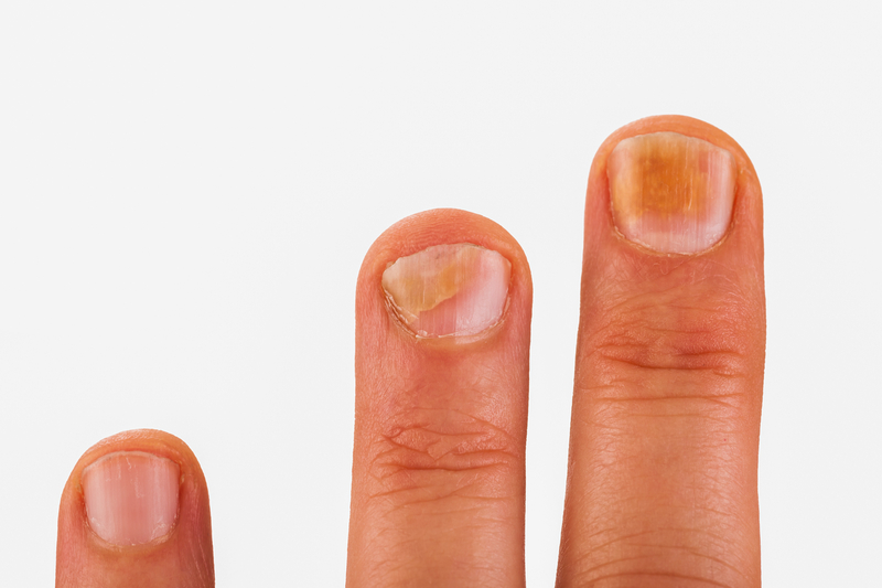 What Do Yellow Fingernails (With or Without Lifting + Pitting) Mean? Organic Olivia » Organic