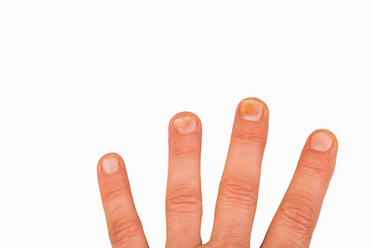 What causes vertical black lines on fingernails? - Dr. Aruna Prasad -  YouTube